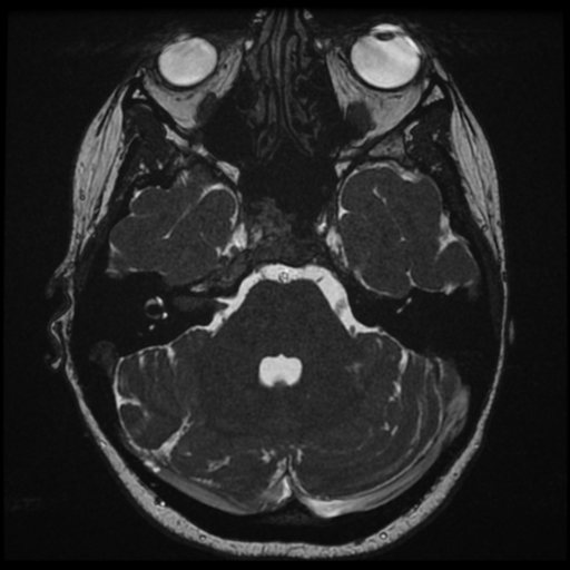 File:Neurofibromatosis type 2 - bilateral acoustic neuromata (Radiopaedia 40060-42566 Axial FIESTA 47).png