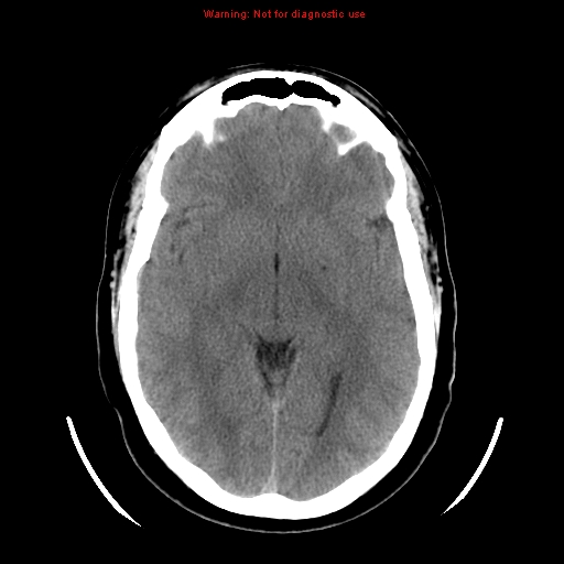 File:Neuroglial cyst (Radiopaedia 10713-11185 Axial non-contrast 18).jpg