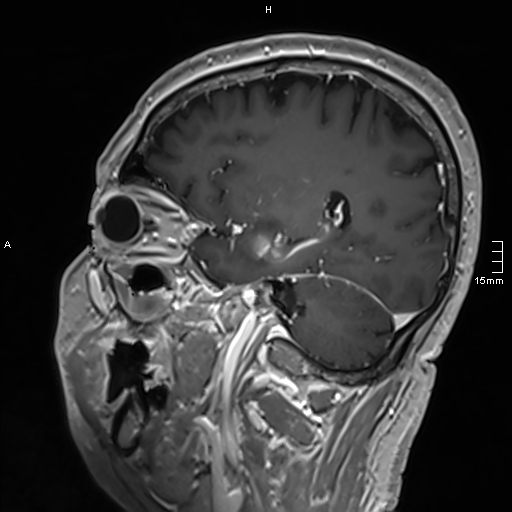 Neurosarcoidosis - involvement of the mesial temporal lobes (Radiopaedia 67429-76820 Sagittal T1 C+ 113).jpg