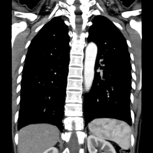File:Non-small cell lung cancer with miliary metastases (Radiopaedia 23995-24193 B 15).jpg