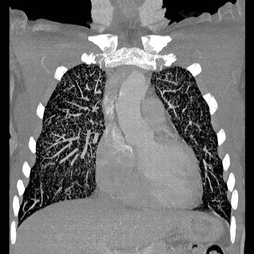 File:Non-small cell lung cancer with miliary metastases (Radiopaedia 23995-24193 Coronal lung window 5).jpg