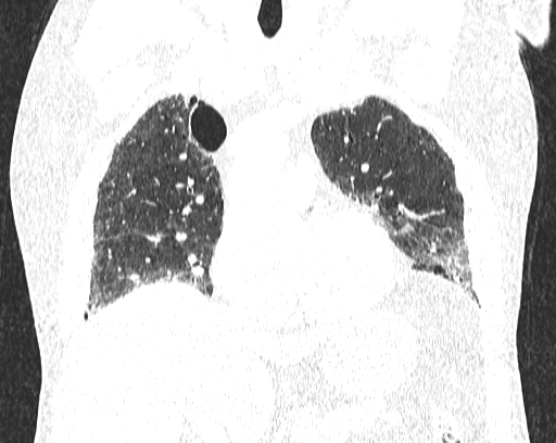 Non-specific interstitial pneumonia (NSIP) (Radiopaedia 68599-78228 Coronal lung window 35).jpg