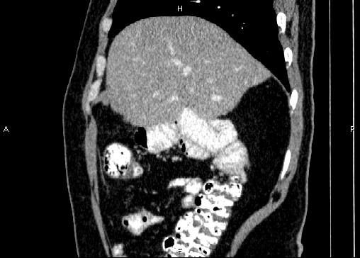 Non-syndromic pancreatic endocrine tumor (Radiopaedia 86958-103178 E 22).jpg