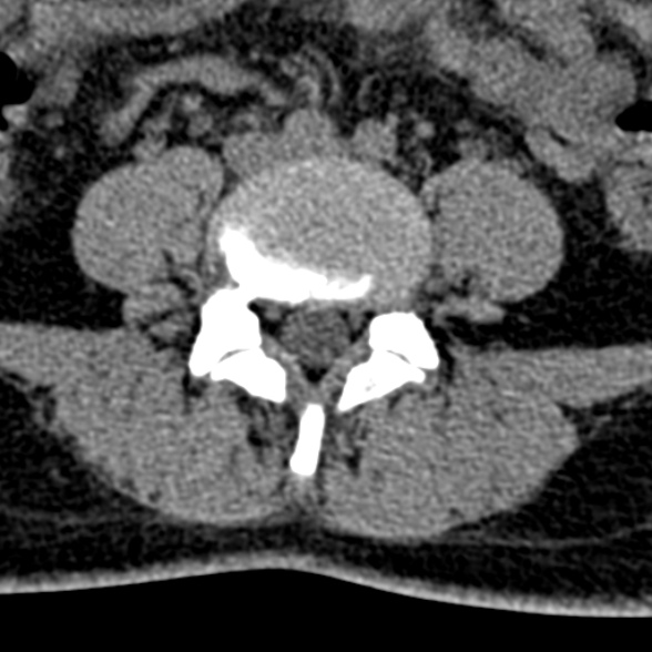 Normal CT lumbar spine (Radiopaedia 53981-60118 Axial non-contrast 72).jpg