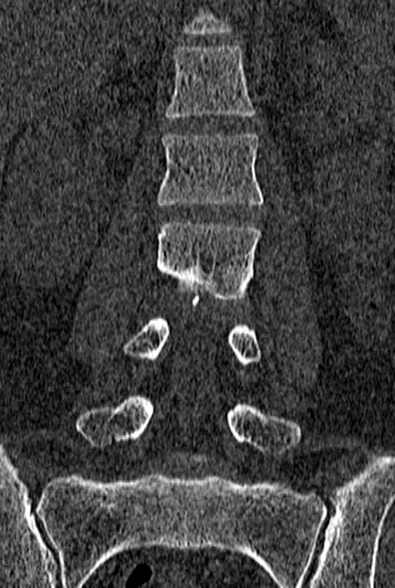 Normal CT lumbar spine (Radiopaedia 53981-60118 Coronal bone window 29).jpg