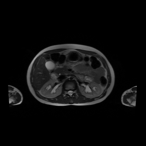 File:Normal MRI abdomen in pregnancy (Radiopaedia 88001-104541 Axial T2 21).jpg