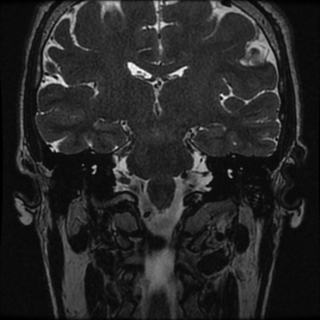 Normal MRI petrous (Radiopaedia 91317-108949 Coronal T2 55).jpg