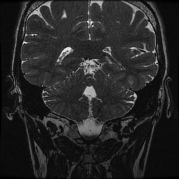 Normal MRI petrous (Radiopaedia 91317-108949 Coronal T2 86).jpg