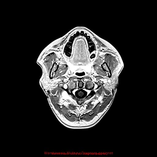 Normal adult brain MRI (non-enhanced and contrast-enhanced) (Radiopaedia 75262-86379 Axial T1 C+ 28).jpg