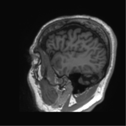 Normal brain MRI (non-focal epilepsy protocol) (Radiopaedia 53917-60040 Sagittal T1 8).png