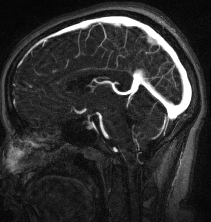 Normal brain MRI and venogram (Radiopaedia 39554-41862 Sagittal MRV 34).jpg