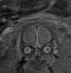 File:Normal brain fetal MRI - 22 weeks (Radiopaedia 50623-56050 Coronal T2 Haste 21).jpg