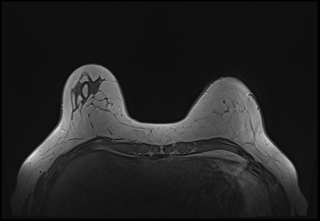 File:Normal breast MRI - dense breasts (Radiopaedia 80454-93850 Axial T1 51).jpg