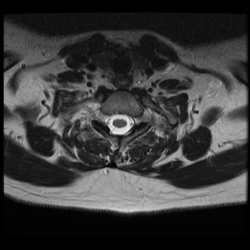 File:Normal cervical and thoracic spine MRI (Radiopaedia 35630-37156 Axial T2 8).png