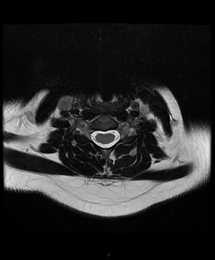 Normal cervical spine MRI (Radiopaedia 80146-93454 Axial T2 53).jpg