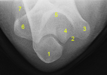 File:Normal elbow (AP acute flexion view) (Radiopaedia 73474-84239 Jones View 1).jpg