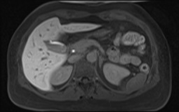 File:Normal hepatobiliary phase liver MRI (Radiopaedia 58968-66230 A 46).jpg