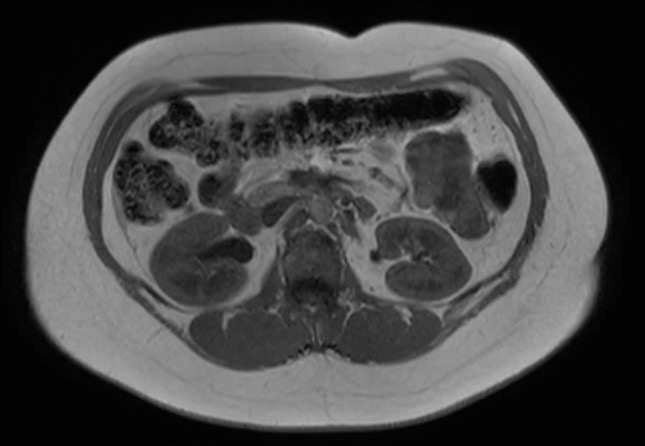 File:Normal liver MRI with Gadolinium (Radiopaedia 58913-66163 Axial T1 in-phase 12).jpg
