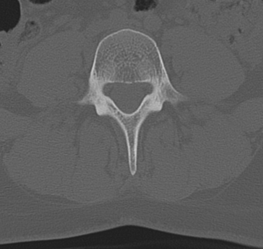 File:Normal lumbar spine CT (Radiopaedia 46533-50986 Axial bone window 48).png