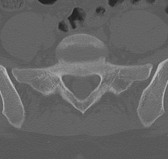 File:Normal lumbar spine CT (Radiopaedia 46533-50986 Axial bone window 66).png
