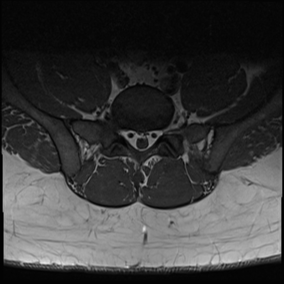 File:Normal lumbar spine MRI (Radiopaedia 47857-52609 Axial T1 28).jpg