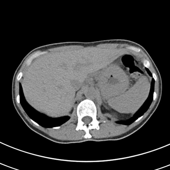 File:Normal multiphase CT liver (Radiopaedia 38026-39996 Axial non-contrast 13).jpg