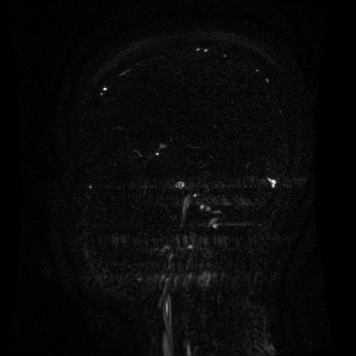 Normal noncontrast MR venography (Radiopaedia 87578-103957 A 114).jpg