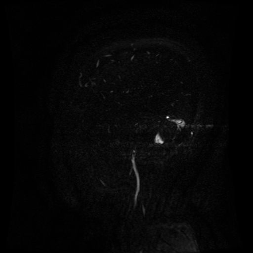 Normal noncontrast MR venography (Radiopaedia 87578-103957 A 25).jpg