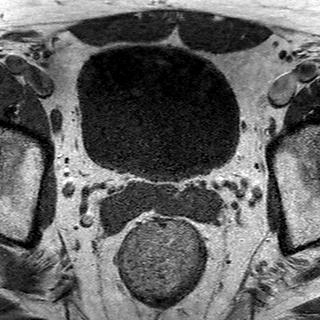 File:Normal prostate (MRI) (Radiopaedia 29986-30535 Axial T1 20).jpg