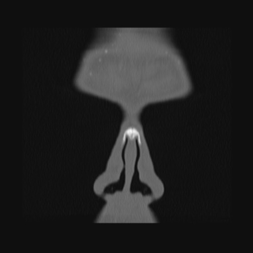 Normal sinus CT (annotated) (Radiopaedia 78917-91810 Coronal bone window 10).jpg