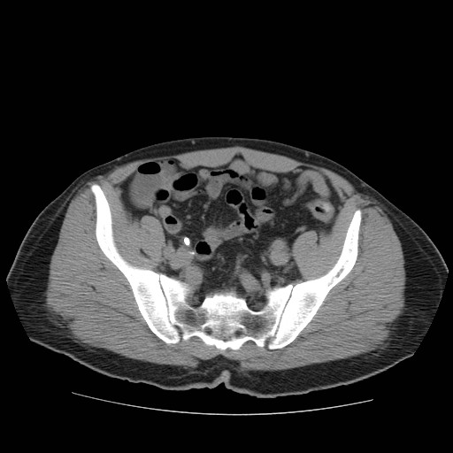 File:Obstructed kidney with perinephric urinoma (Radiopaedia 26889-27067 Axial non-contrast 50).jpg