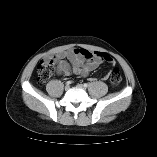 File:Obstructing ureteric calculus (Radiopaedia 18615-18514 B 38).jpg