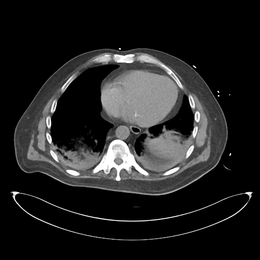File:Obstructive pyelonephritis (Radiopaedia 46411-50844 Axial non-contrast 9).png