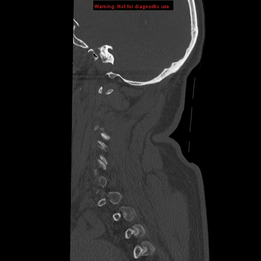 File:Occipital condyle fracture (Radiopaedia 18366-18208 Sagittal bone window 33).jpg