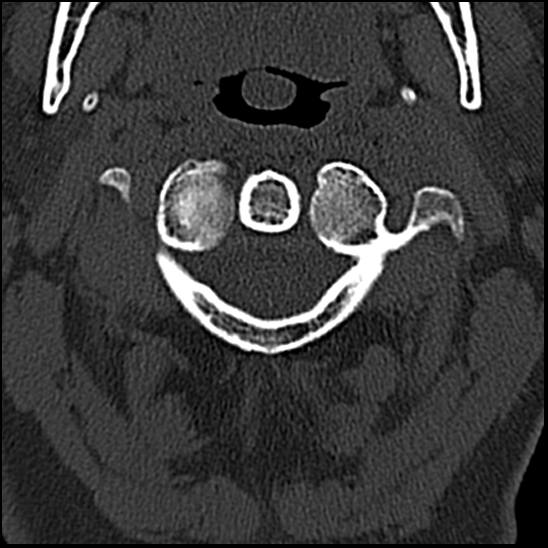 Occipital condyle fracture (type 1) (Radiopaedia 87670-104084 Axial bone window 21).jpg