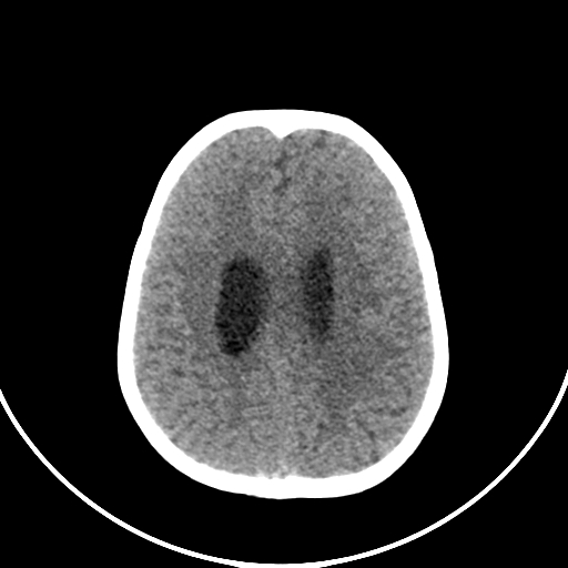 Occipital encephalocele (Radiopaedia 87339-103636 Axial non-contrast 61).jpg