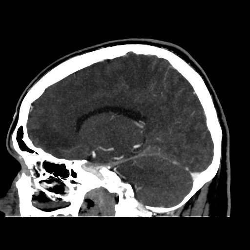 Occipital extradural hematoma simulating venous sinus thrombosis (Radiopaedia 46514-50964 D 46).jpg