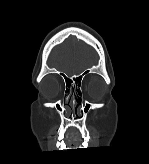 Occipital spur and Currarino type A atlas anomaly (Radiopaedia 87027-103285 Coronal bone window 35).jpg