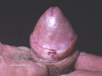 File:Penile lichen sclerosus (DermNet NZ 091-small).jpg