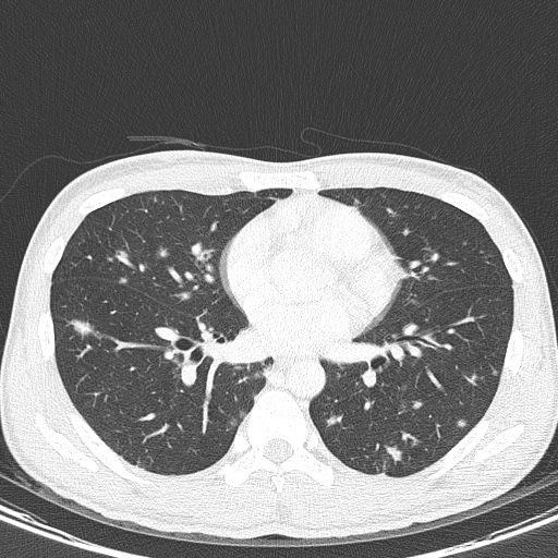 AIDS-related Kaposi sarcoma (Radiopaedia 85247-100811 Axial lung window 98).jpg