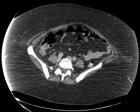 File:Abdominal abscess - pre and post percutaneous drainage (Radiopaedia 60209-67816 Axial 60).png