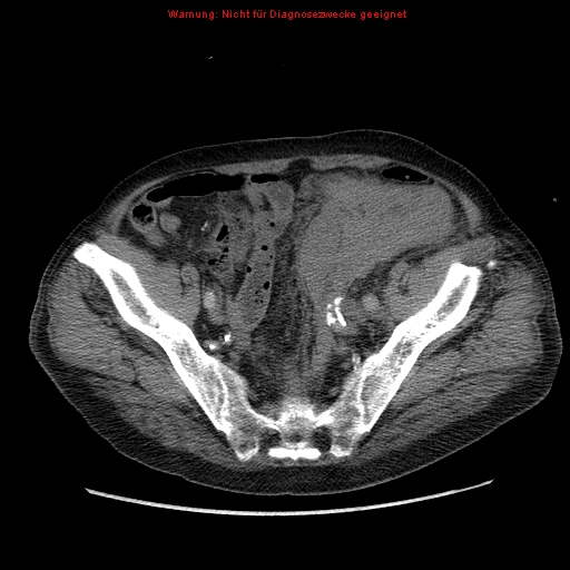 Abdominal aortic aneurysm- extremely large, ruptured (Radiopaedia 19882-19921 Axial C+ arterial phase 63).jpg