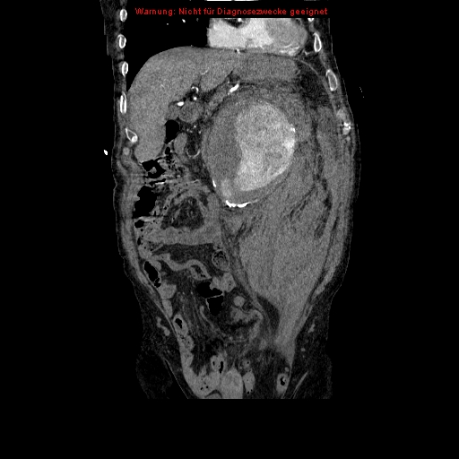 Abdominal aortic aneurysm- extremely large, ruptured (Radiopaedia 19882-19921 Coronal C+ arterial phase 35).jpg