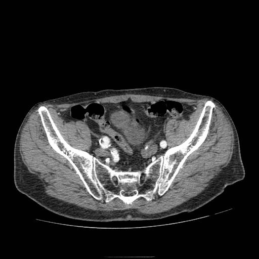 Abdominal aortic aneurysm (Radiopaedia 13341-13340 Axial C+ arterial phase 202).jpg