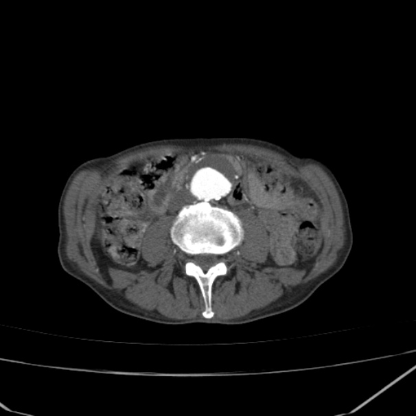 Abdominal aortic aneurysm (Radiopaedia 23703-23856 Axial C+ arterial phase 44).jpg