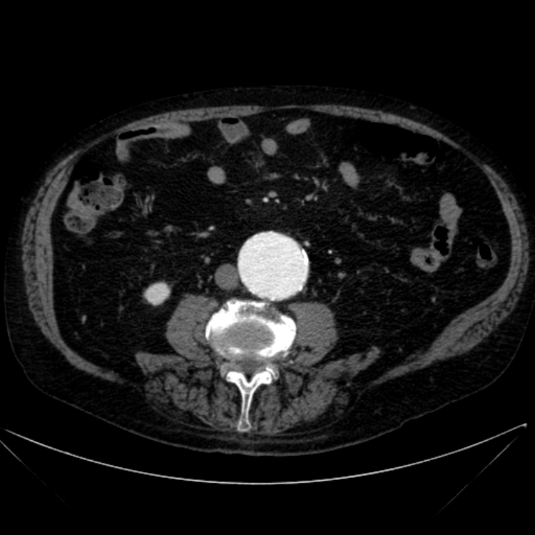 Abdominal aortic aneurysm (Radiopaedia 25855-26001 Axial C+ arterial phase 75).jpg