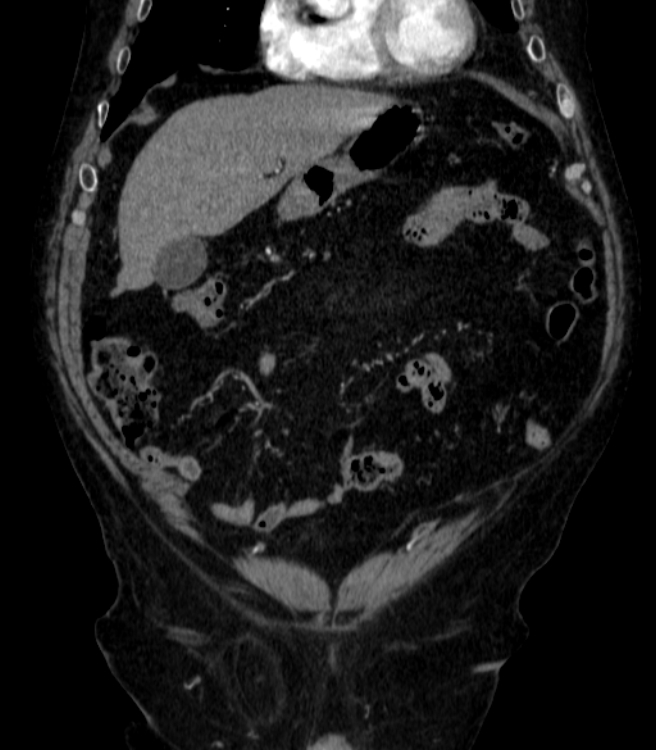 Abdominal aortic aneurysm (Radiopaedia 25855-26001 Coronal C+ arterial phase 3).jpg