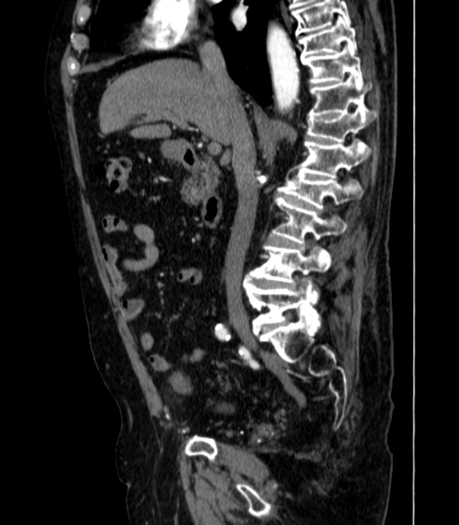 Abdominal aortic aneurysm (Radiopaedia 25855-26001 Sagittal C+ arterial phase 15).jpg