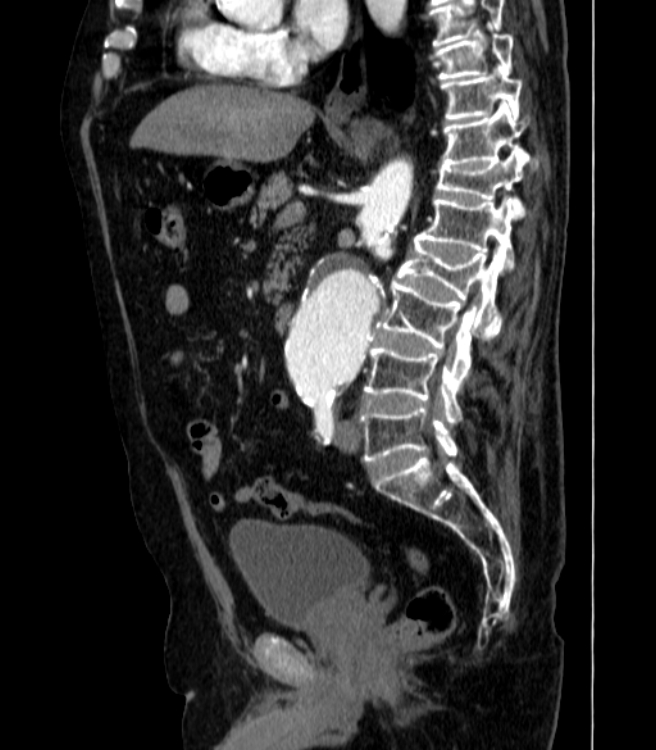 Abdominal aortic aneurysm (Radiopaedia 25855-26001 Sagittal C+ arterial phase 28).jpg