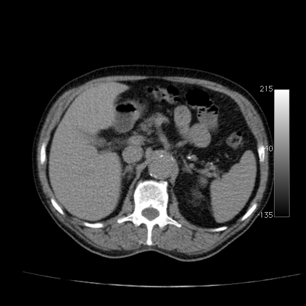 Abdominal aortic aneurysm (Radiopaedia 29248-29660 Axial non-contrast 18).jpg